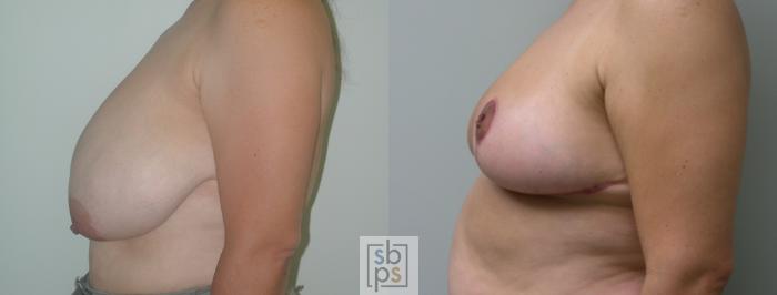 Before & After Breast Reduction Case 52 View #2 View in Torrance, CA