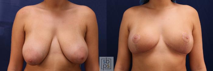 Before & After Breast Reduction Case 526 Front View in Torrance, CA
