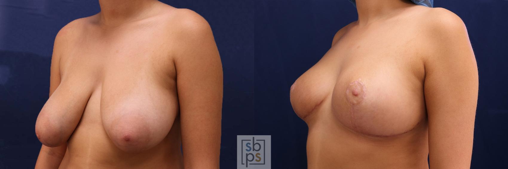 Before & After Breast Reduction Case 526 Left Oblique View in Torrance & Los Angeles, CA, CA