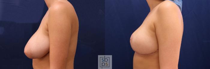 Before & After Breast Reduction Case 526 Left Side View in Torrance, CA