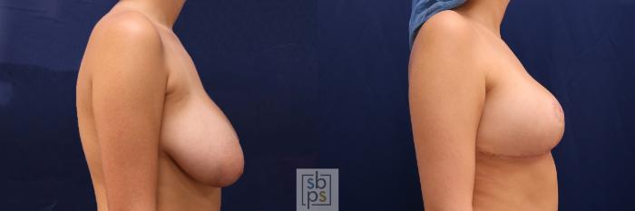 Before & After Breast Reduction Case 526 Right Side View in Torrance, CA