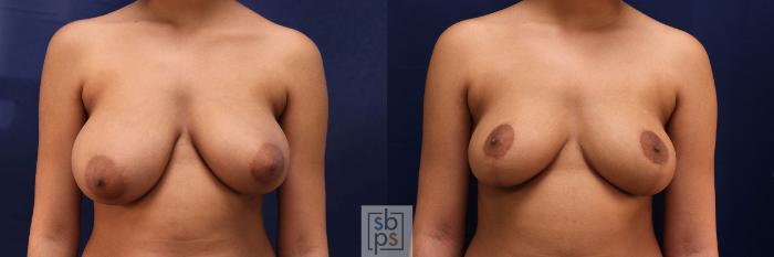 Before & After Breast Reduction Case 527 Front View in Torrance, CA