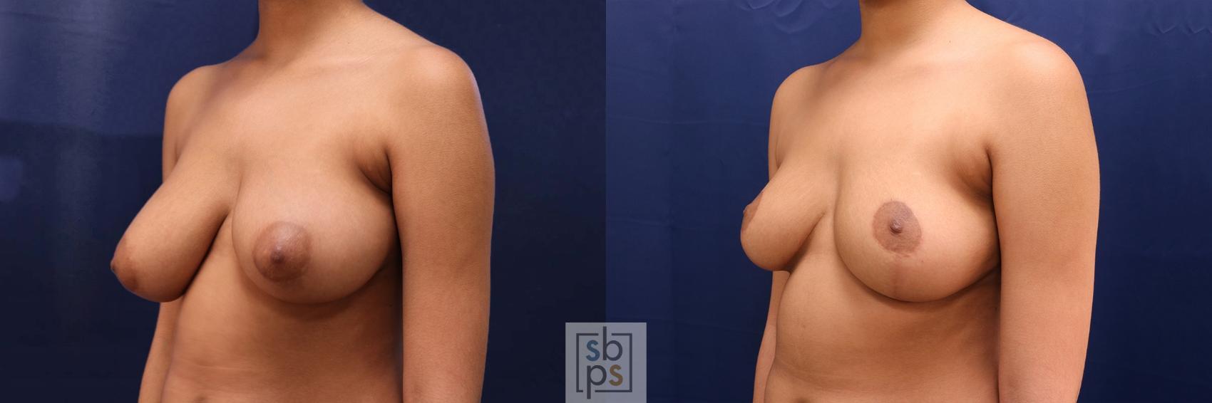 Before & After Breast Reduction Case 527 Left Oblique View in Torrance & Los Angeles, CA, CA