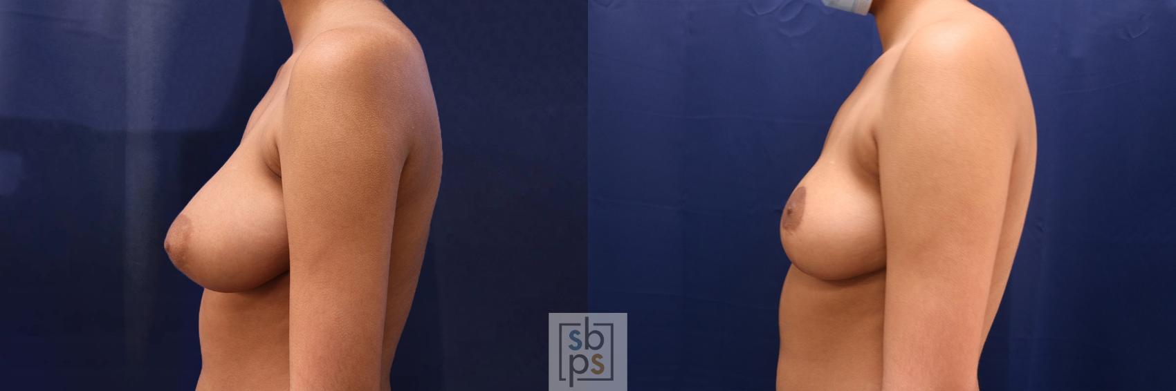 Before & After Breast Reduction Case 527 Left Side View in Torrance & Los Angeles, CA, CA