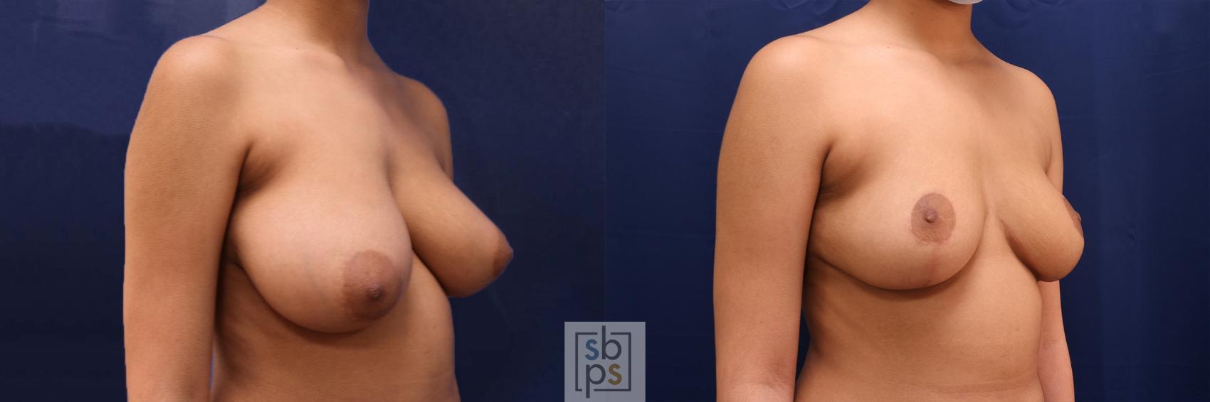 Before & After Breast Reduction Case 527 Right Oblique View in Torrance & Los Angeles, CA, CA