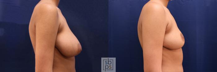 Before & After Breast Reduction Case 527 Right Side View in Torrance, CA