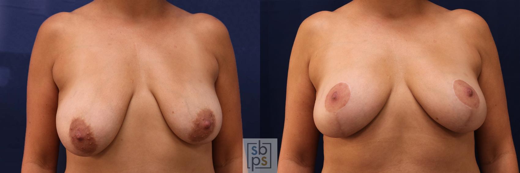 Before & After Breast Reduction Case 529 Front View in Torrance, CA