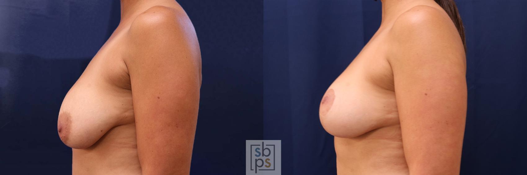 Before & After Breast Reduction Case 529 Left Side View in Torrance & Los Angeles, CA, CA