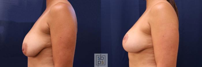 Before & After Breast Reduction Case 529 Left Side View in Torrance, CA
