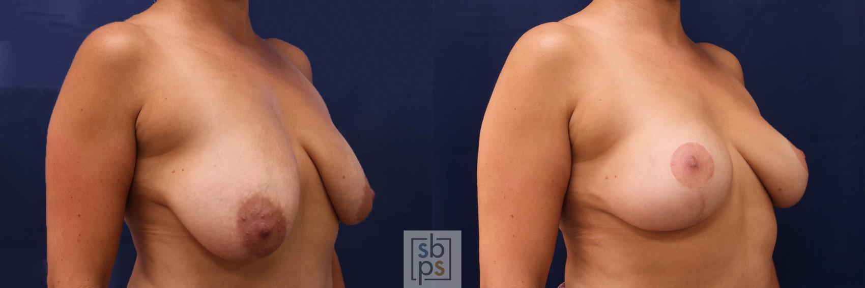 Before & After Breast Reduction Case 529 Right Oblique View in Torrance & Los Angeles, CA, CA