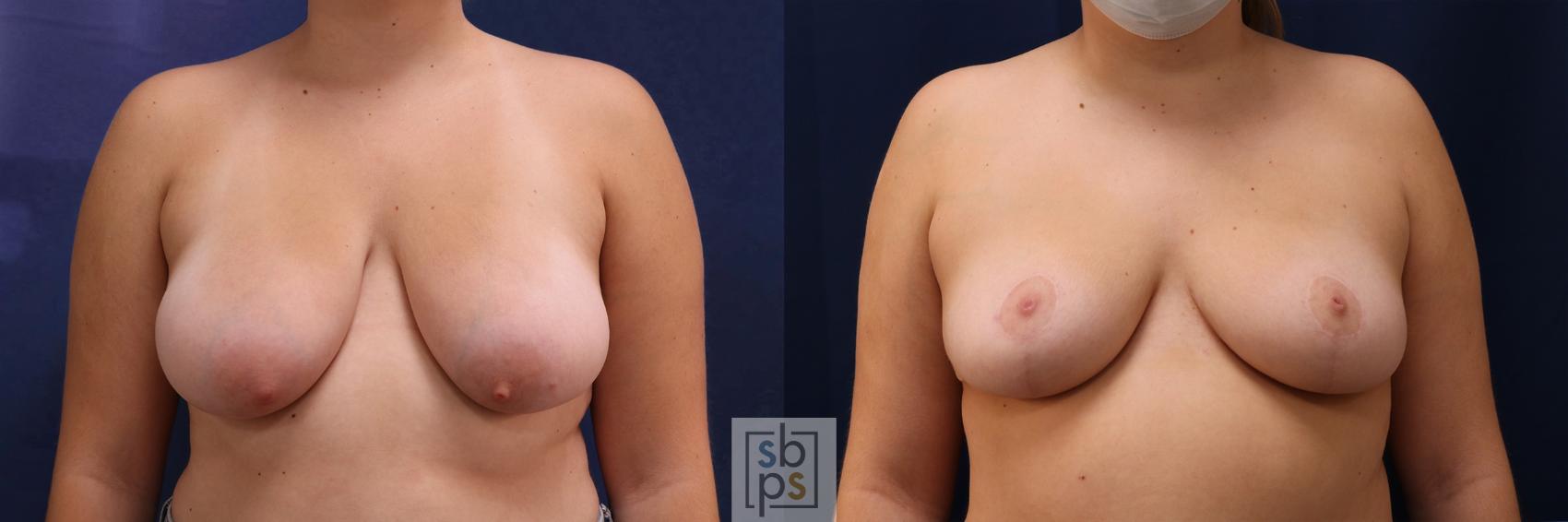 Before & After Breast Reduction Case 531 Front View in Torrance, CA