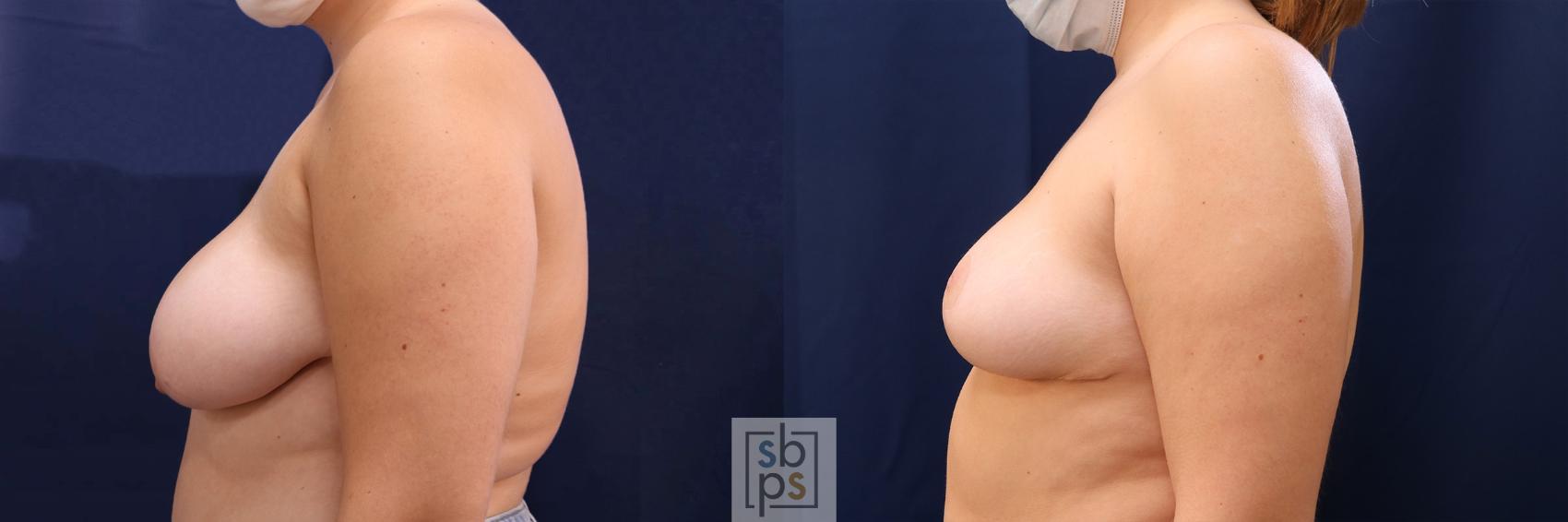 Before & After Breast Reduction Case 531 Left Side View in Torrance & Los Angeles, CA, CA