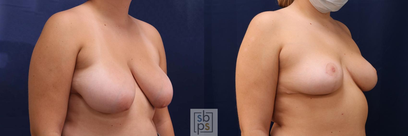 Before & After Breast Reduction Case 531 Right Oblique View in Torrance & Los Angeles, CA, CA