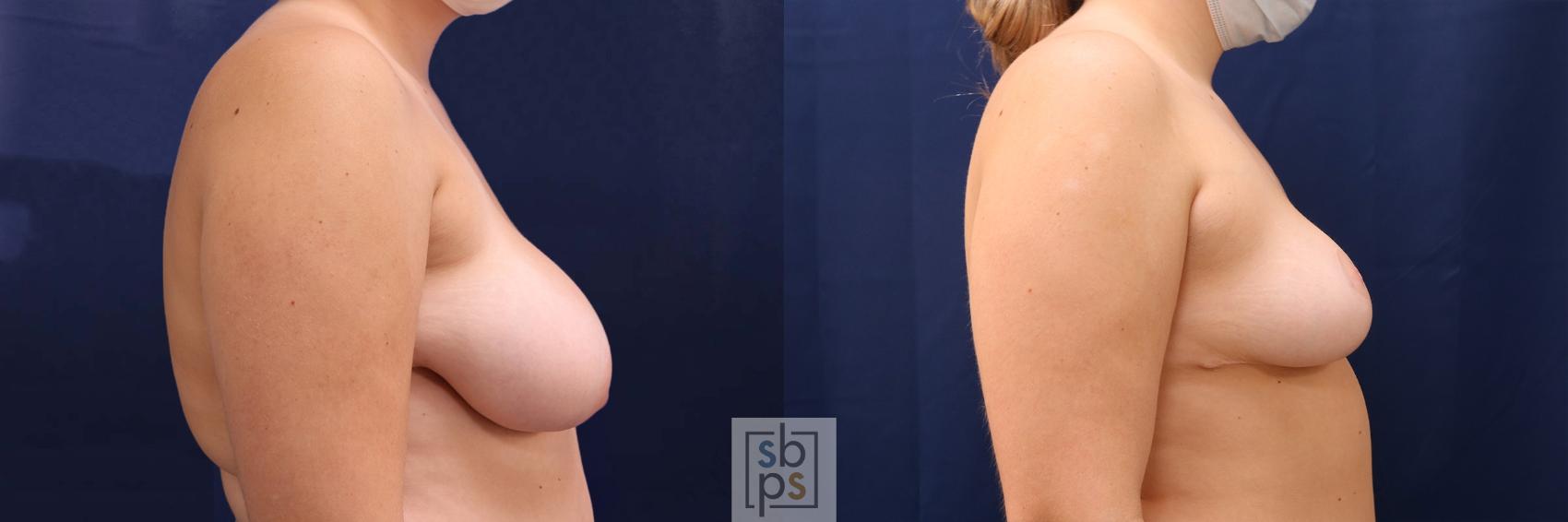Before & After Breast Reduction Case 531 Right Side View in Torrance & Los Angeles, CA, CA