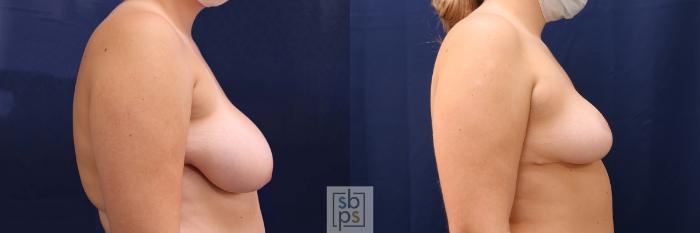 Before & After Breast Reduction Case 531 Right Side View in Torrance, CA