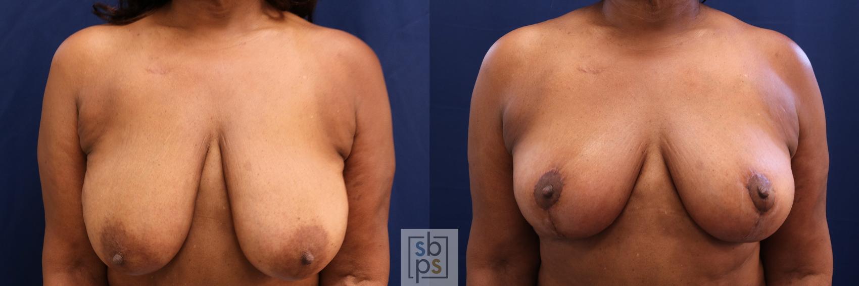 Before & After Breast Reduction Case 533 Front View in Torrance, CA