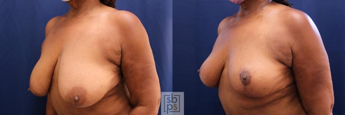 Before & After Breast Reduction Case 533 Left Oblique View in Torrance, CA