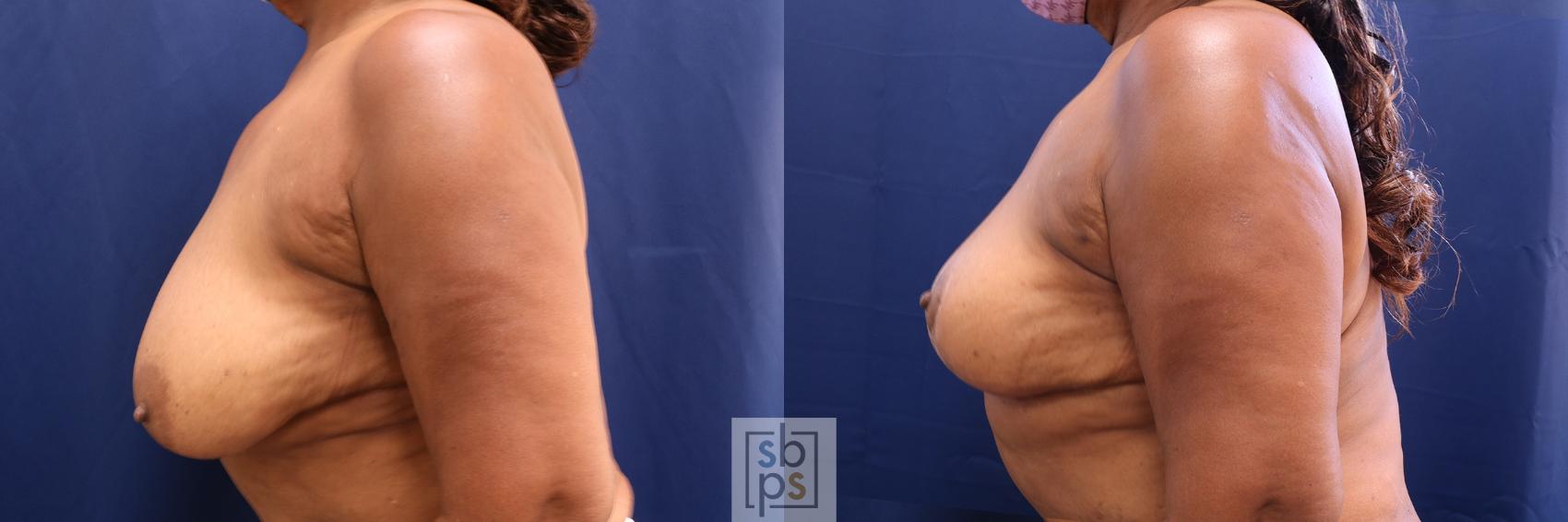 Before & After Breast Reduction Case 533 Left Side View in Torrance & Los Angeles, CA, CA