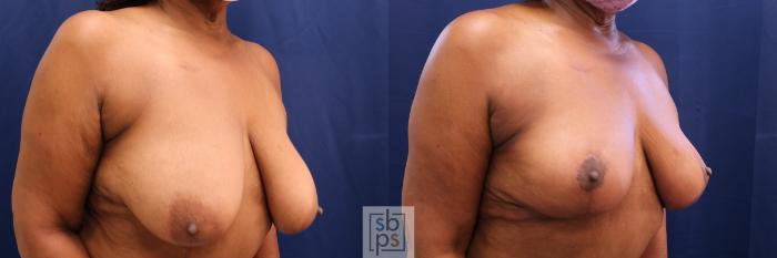 Before & After Breast Reduction Case 533 Right Oblique View in Torrance, CA