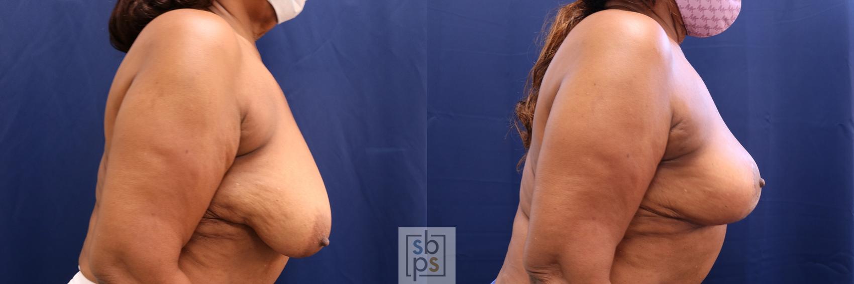 Before & After Breast Reduction Case 533 Right Side View in Torrance & Los Angeles, CA, CA