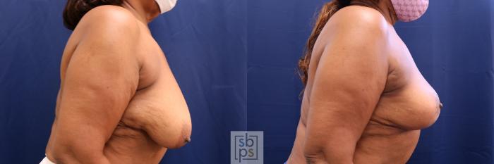 Before & After Breast Reduction Case 533 Right Side View in Torrance, CA