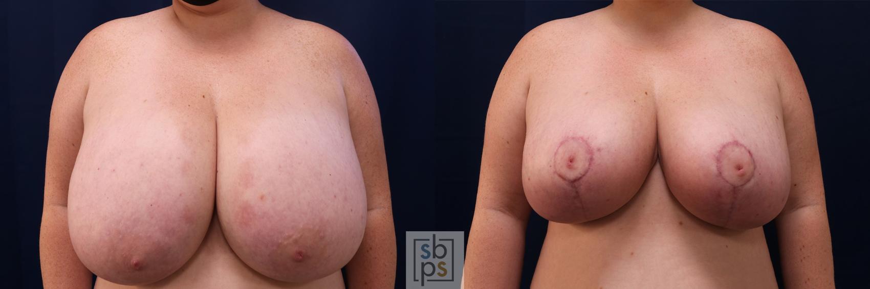Before & After Breast Reduction Case 539 Front View in Torrance, CA