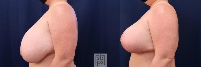 Before & After Breast Reduction Case 539 Left Side View in Torrance, CA