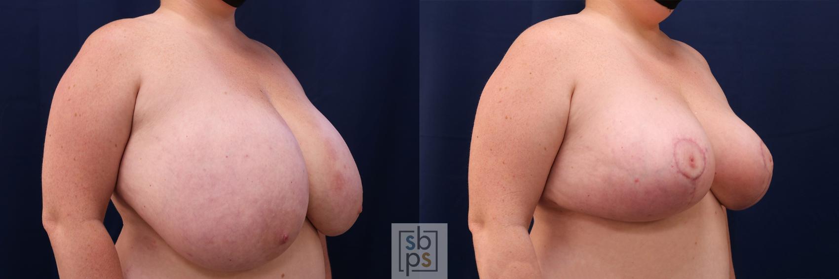 Before & After Breast Reduction Case 539 Right Oblique View in Torrance & Los Angeles, CA, CA
