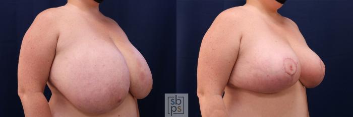 Before & After Breast Reduction Case 539 Right Oblique View in Torrance, CA