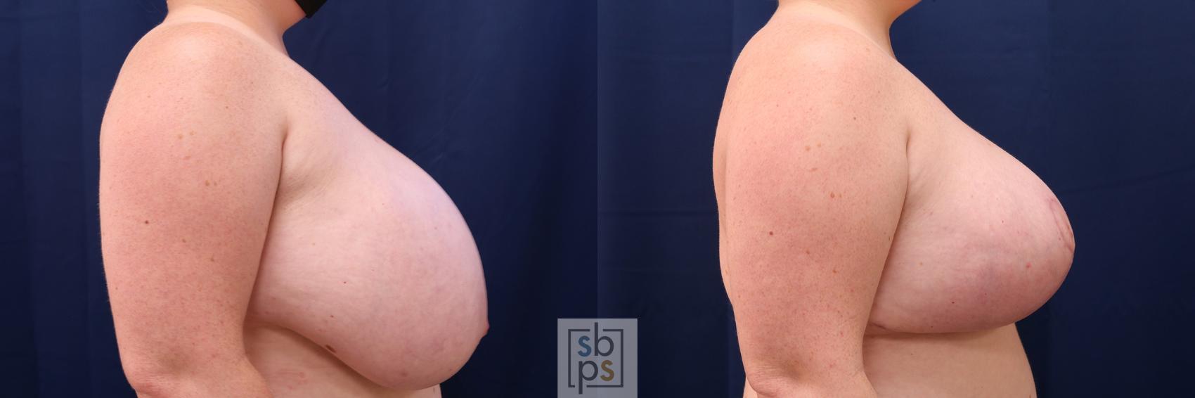 Before & After Breast Reduction Case 539 Right Side View in Torrance & Los Angeles, CA, CA