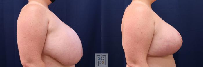 Before & After Breast Reduction Case 539 Right Side View in Torrance, CA