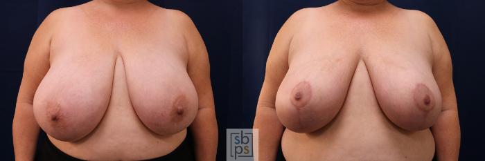 Before & After Breast Reduction Case 540 Front View in Torrance, CA
