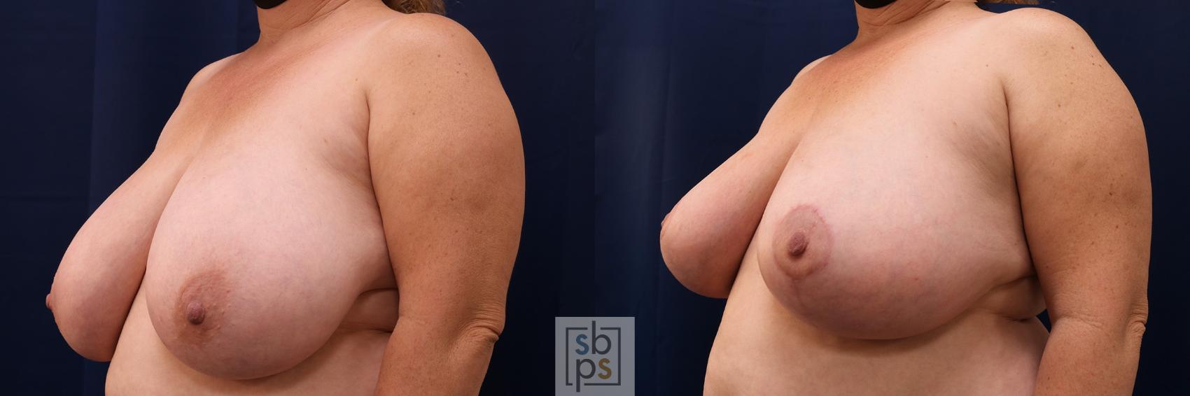 Before & After Breast Reduction Case 540 Left Oblique View in Torrance & Los Angeles, CA, CA