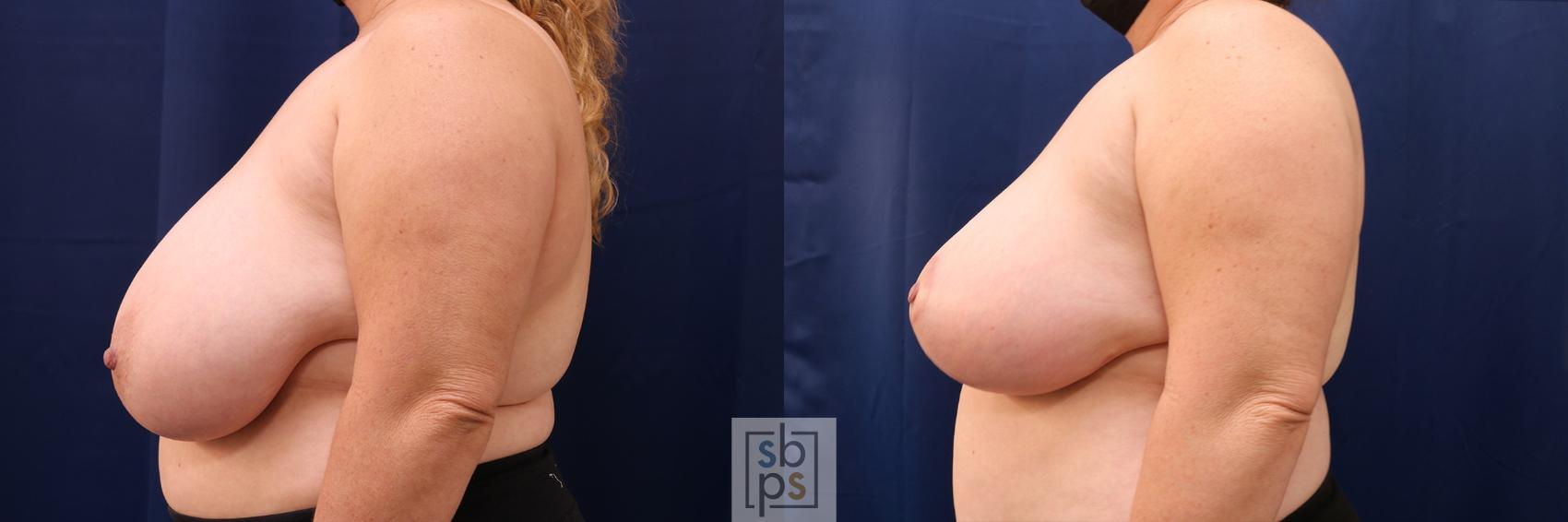 Before & After Breast Reduction Case 540 Left Side View in Torrance & Los Angeles, CA, CA