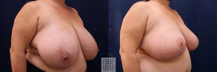 Before & After Breast Reduction Case 540 Right Oblique View in Torrance, CA