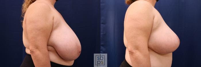 Before & After Breast Reduction Case 540 Right Side View in Torrance, CA