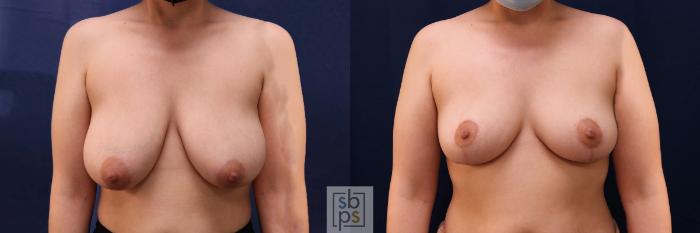 Before & After Breast Reduction Case 543 Front View in Torrance, CA