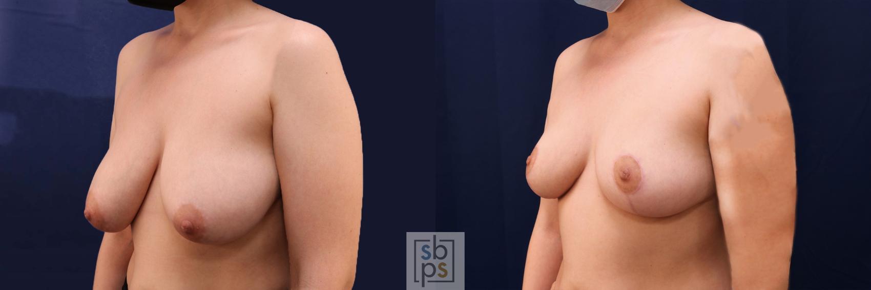 Before & After Breast Reduction Case 543 Left Oblique View in Torrance & Los Angeles, CA, CA