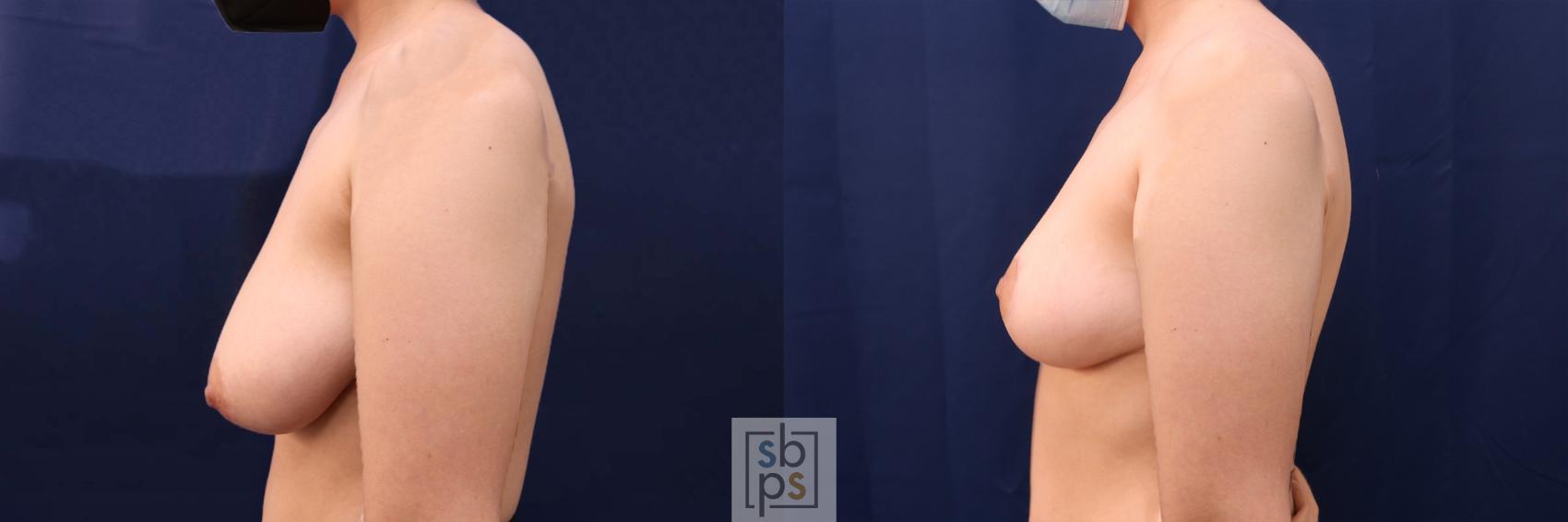 Before & After Breast Reduction Case 543 Left Side View in Torrance & Los Angeles, CA, CA
