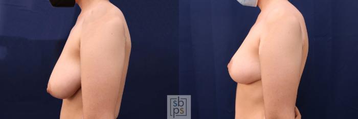 Before & After Breast Reduction Case 543 Left Side View in Torrance, CA
