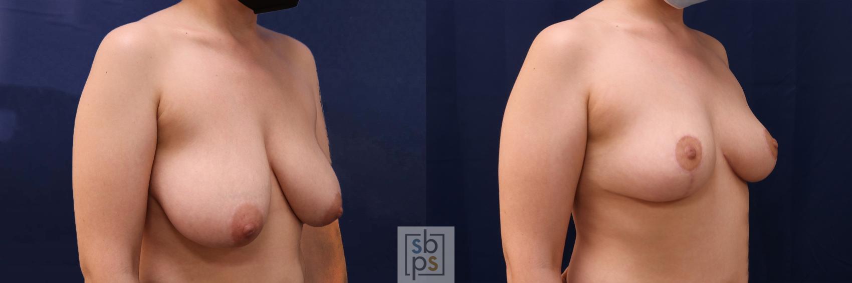 Before & After Breast Reduction Case 543 Right Oblique View in Torrance & Los Angeles, CA, CA