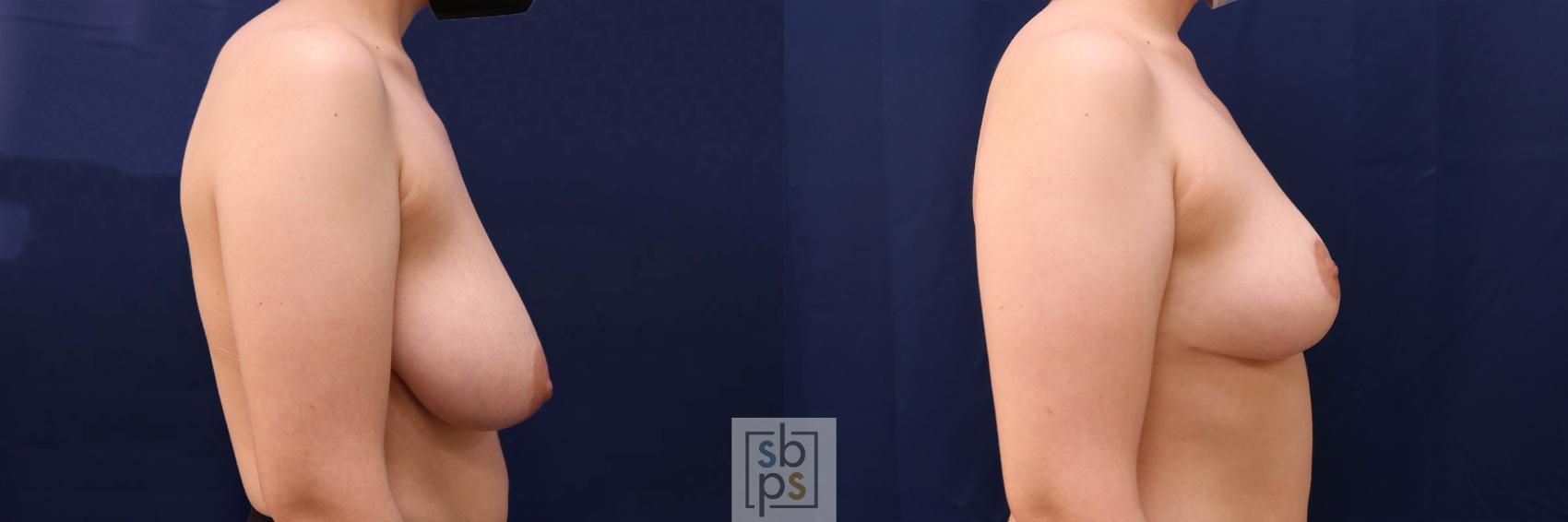 Before & After Breast Reduction Case 543 Right Side View in Torrance & Los Angeles, CA, CA