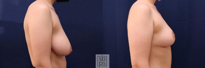 Before & After Breast Reduction Case 543 Right Side View in Torrance, CA