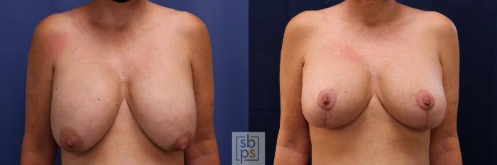 Before & After Breast Reduction Case 547 Front View in Torrance, CA