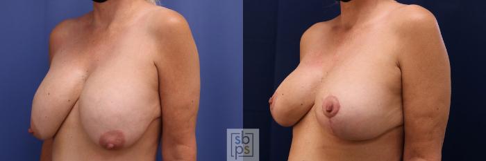 Before & After Breast Reduction Case 547 Left Oblique View in Torrance, CA