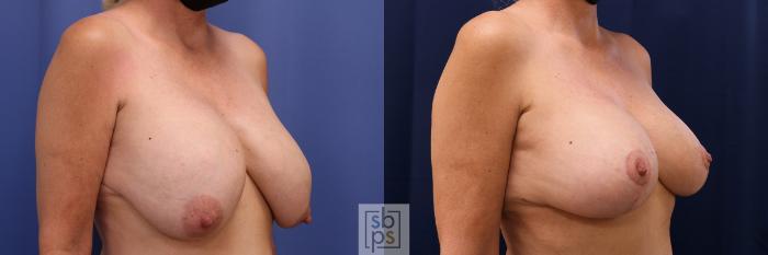 Before & After Breast Reduction Case 547 Right Oblique View in Torrance, CA