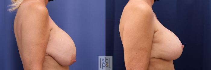 Before & After Breast Reduction Case 547 Right Side View in Torrance, CA