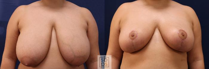 Before & After Breast Reduction Case 561 Front View in Torrance, CA