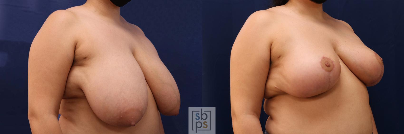 Before & After Breast Reduction Case 561 Left Oblique View in Torrance & Los Angeles, CA, CA