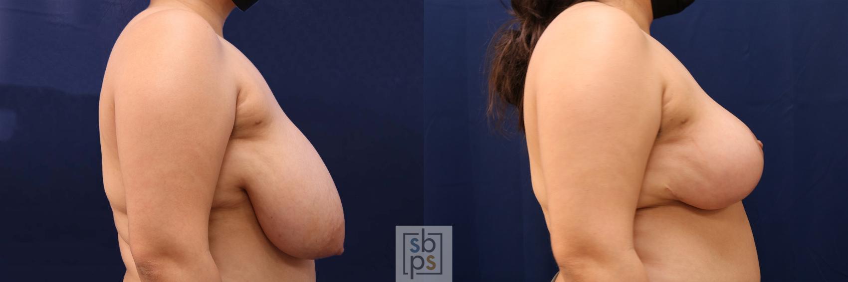 Before & After Breast Reduction Case 561 Left Side View in Torrance & Los Angeles, CA, CA